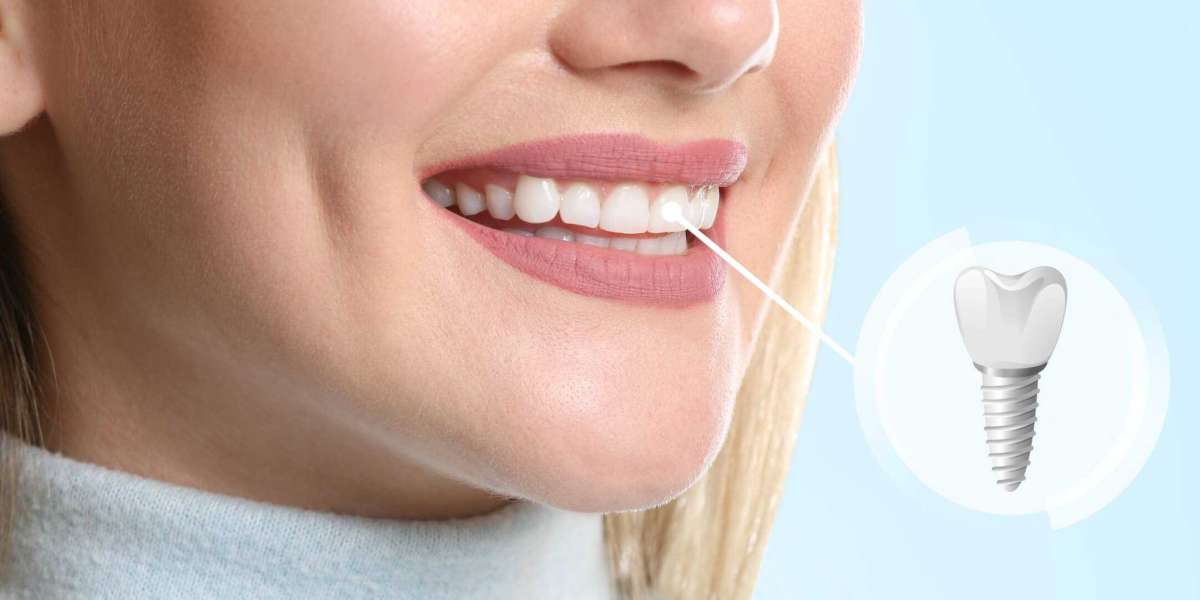 Dental Implants in Hertfordshire: Your Guide to a Confident Smile