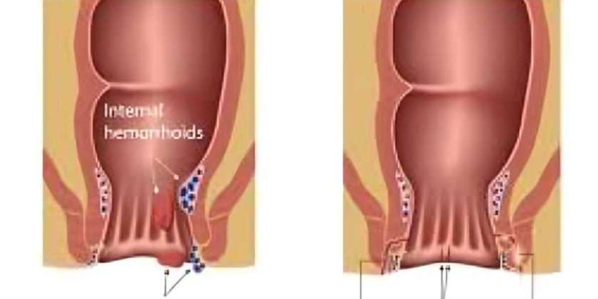 Difference Between Internal Piles and External Piles