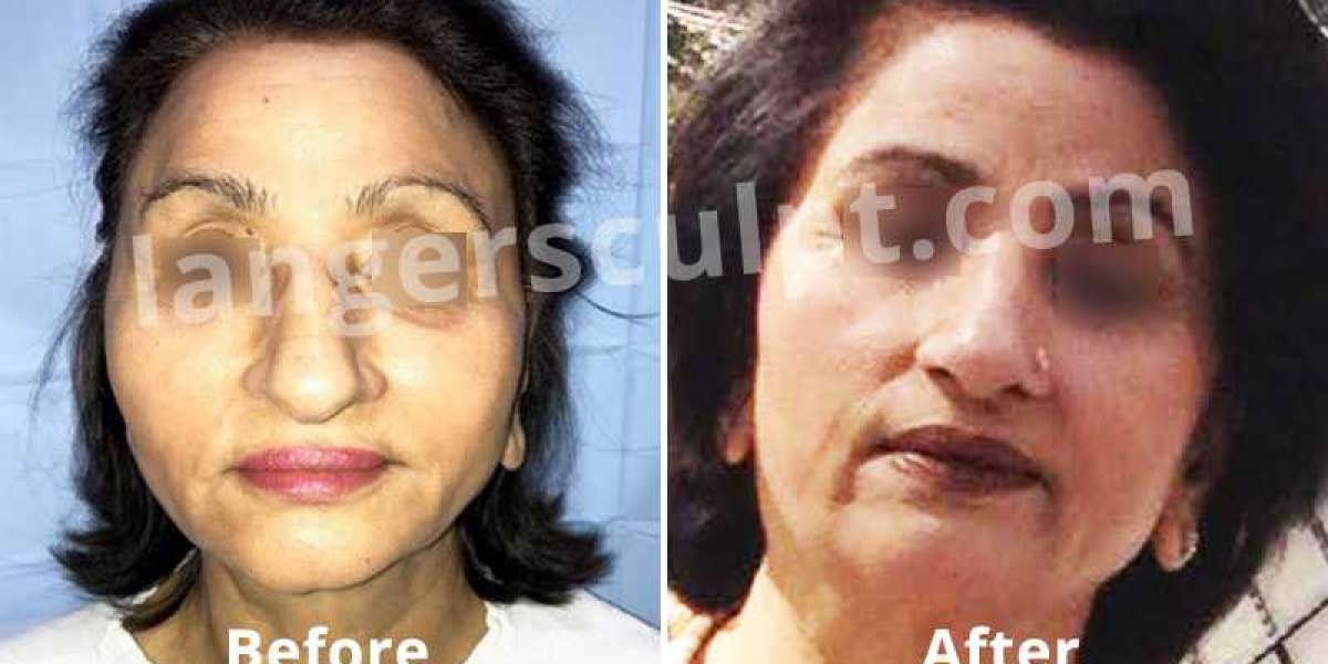 Best Plastic Surgeon in Delhi