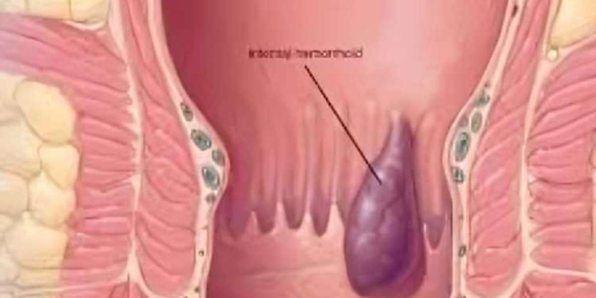 About hydrocortisone for piles and itchy bottom